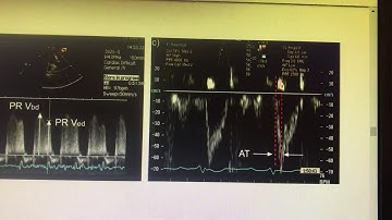 Pulmonary acceleration time