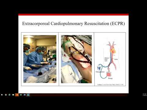 Video: Potencijalni Učinci Novog Integriranog Tijeka Ekstrakorporalnog CPR-a Primjenom Interventne Radiologije I Neposrednog Sustava Računalne Tomografije Cijelog Tijela Na Odjelu Za Hitn
