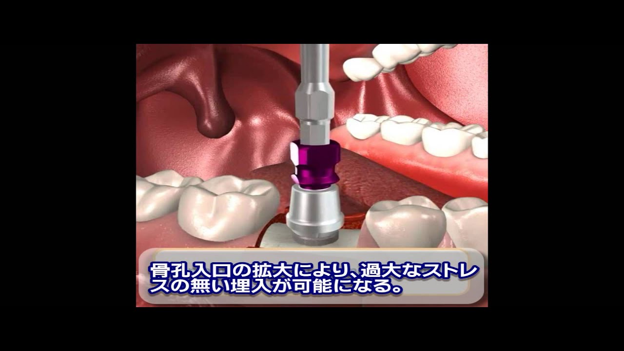 外科術式マニュアル|株式会社インプラテックス