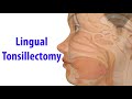 Lingual Tonsillectomy