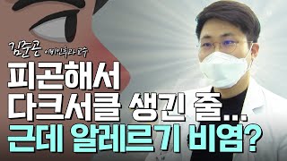 &#39;다크서클 심하다면?&#39;..알레르기성 비염 주의 ｜1분 건강