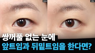 시선성형외과 무쌍트임, 쌍꺼풀없는 눈에서 앞트임+뒤밑트임 효과는?