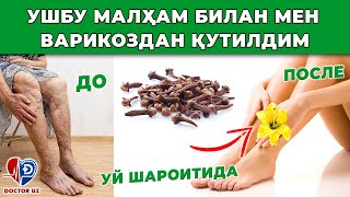 КУЧЛИ ОҒРИҚЛАРДАН ЎРНИМДАН ТУРОЛМАС ЭДИМ. ЭНДИ ЭСА ЮГУРИБ ЮРИБМАН. УШБУ МАЛҲАМ ВАРИКОЗНИ ЙЎҚ ҚИЛДИ