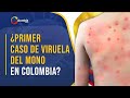 Colombia: autoridades investigan la presencia de un presunto caso de la ‘viruela del mono’.