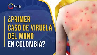 Colombia: autoridades investigan la presencia de un presunto caso de la ‘viruela del mono’.