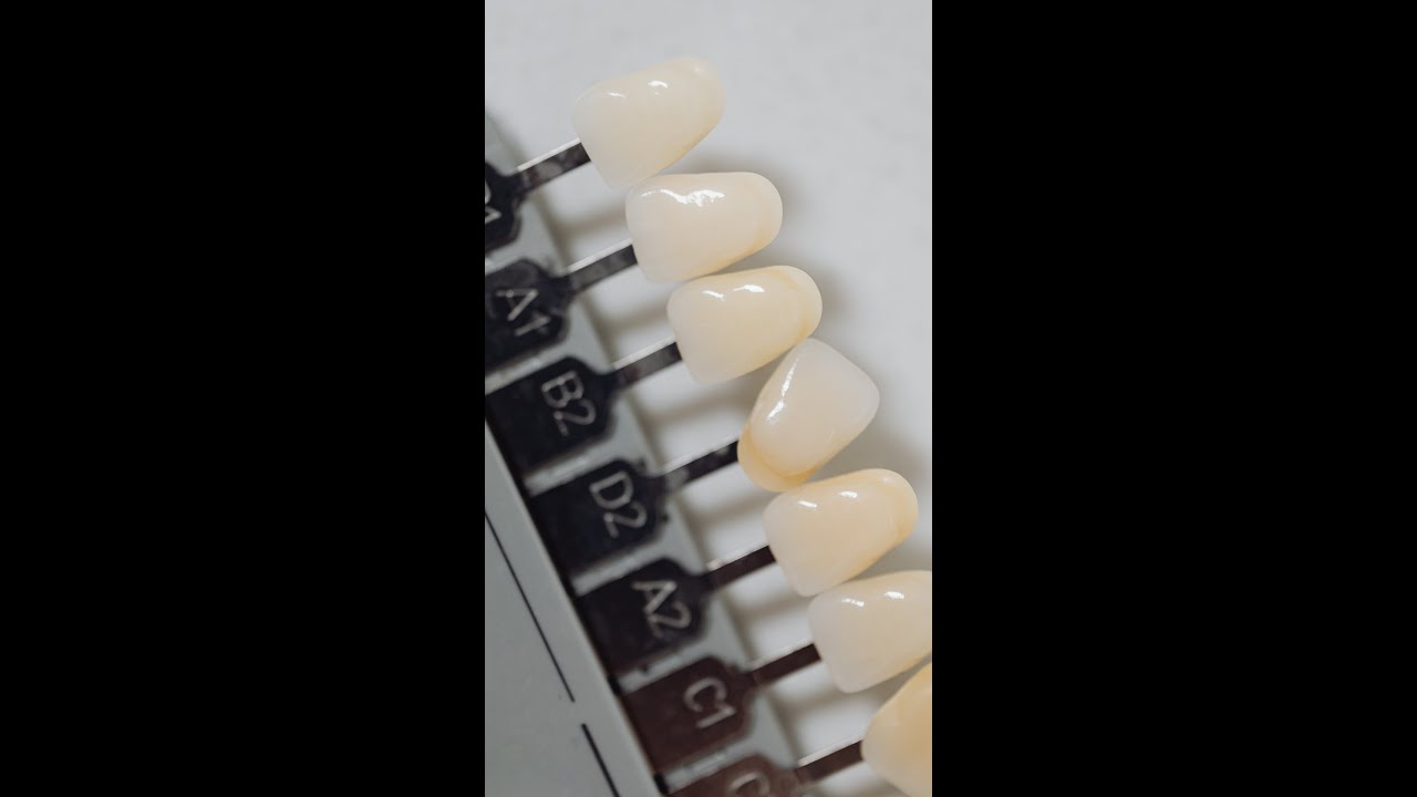 Dental Veneer Alternatives