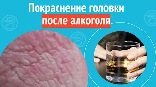 🍺 Покраснение головки после алкоголя. Клинический случай №1243