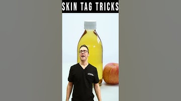 How To Get Rid Of Skin Tags & Wart Removal [Apple Cider Vinegar]