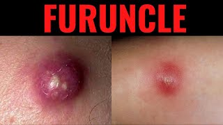 What is Furuncle? Furuncle (Boil) Definition,Causes, Symptoms, Risk Factors, Prevention