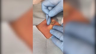 Popping huge blackheads and Pimple Popping - Best Pimple Popping Videos 27