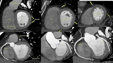 Triple rule out CT protocol