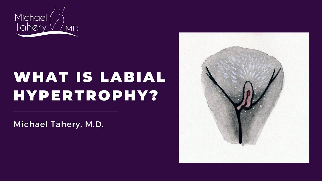 What is Labial Hypertrophy?