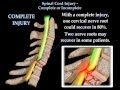 Spinal Cord Injury Complete Or Incomplete - Everything You Need To Know - Dr. Nabil Ebraheim