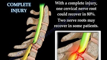 Spinal Cord Injury Complete Or Incomplete - Everything You Need To Know - Dr. Nabil Ebraheim