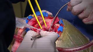 Craniotomy for Resection of Frontal Meningioma