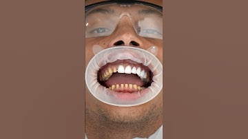 Veneers can change your smile forever  #dentist #shorts #zirconiacrown