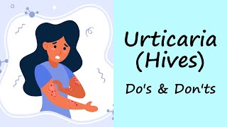 Urticaria (Hives) | Do