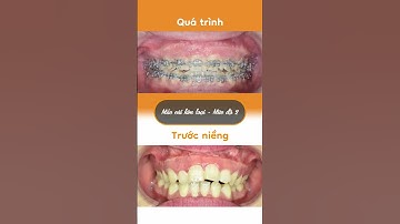 Hành trình LỘT XÁC nhờ niềng răng của Nguyễn Thị Hợp