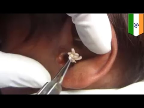 WARNING: GRAPHIC. Buhay na uod, tinanggal mula sa tenga ng Indian na lalake! WARNING: GRAPHIC. Buhay na uod, tinanggal mula sa tenga ng Indian na lalake!