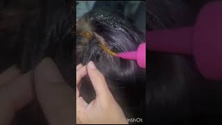 hairfall treatment hairfallsolution shortvideo viral