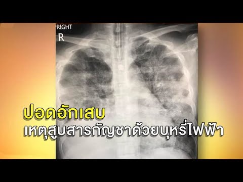 หมอโพสต์เตือน คนไข้มะเร็งปอด ลดกินยาหมอ หันไปสูบสารกัญชาด้วยบุหรี่ไฟฟ้า สุดท้ายอาการทรุด