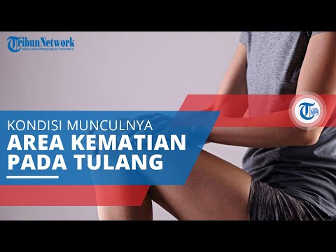 Video: Siapa yang mengobati nekrosis avaskular tulang?