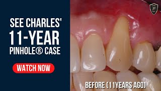 See 6-Year and 11-Year Chao Pinhole® Surgical Technique results