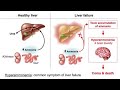 Hepatic Encephalopathy by Dr Gireesh Kumar KP