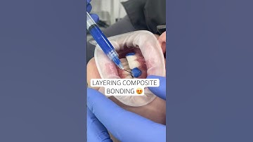 Dr. Charlie layering composite and transforming this smile. 😍 #compositebonding #ruhdental