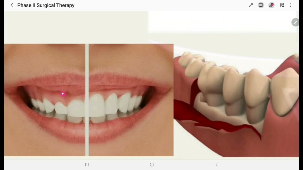 بريو مرحلة رابعة محاضرة Phase II Surgical Therapy الجزء الأول 