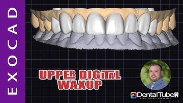 Exocad 3.2 Upper Digital Waxup