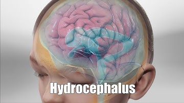 Hydrocefalie