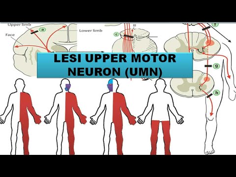 Video: Cara Mendiagnosis Penyakit Motor Neuron (Dengan Gambar)