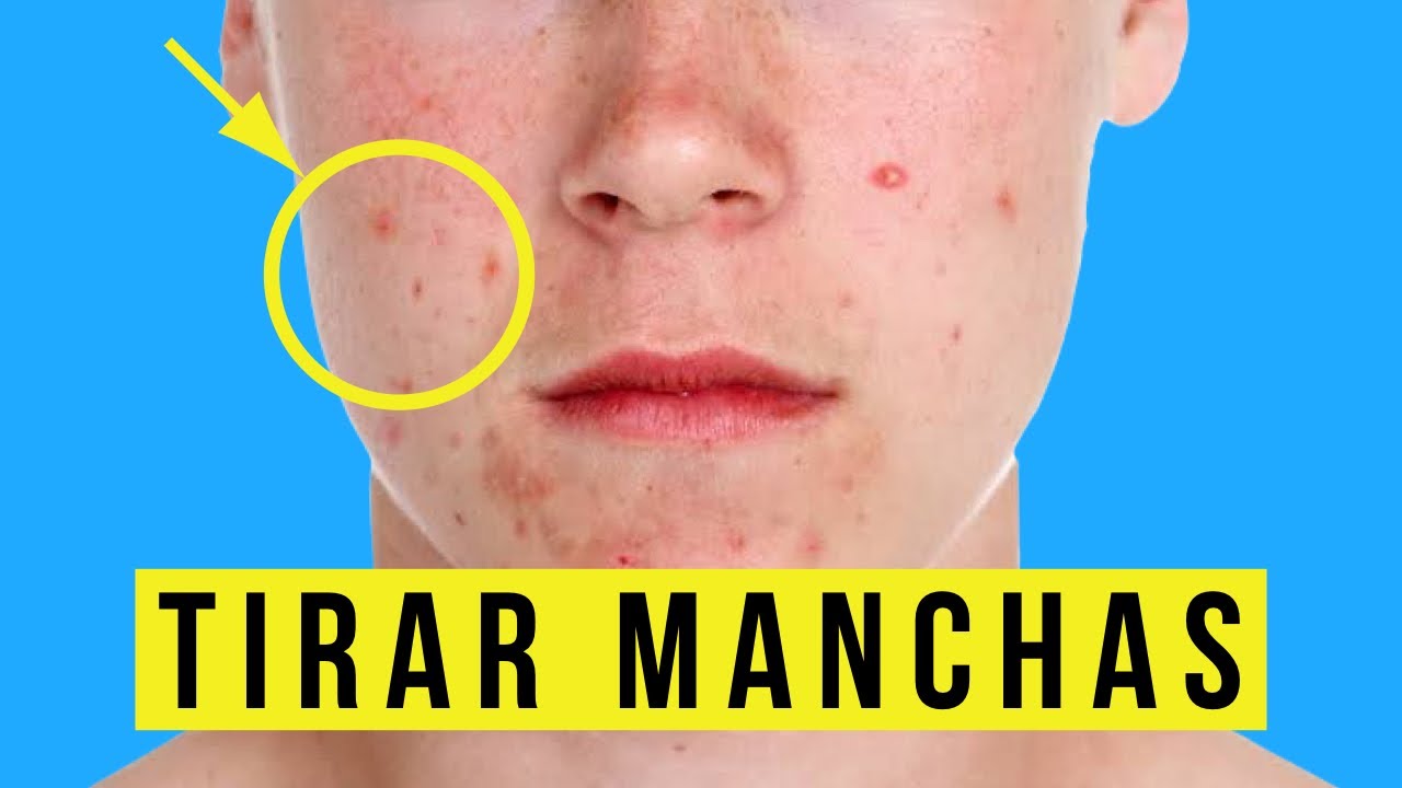 COMO TIRAR MANCHAS DE ESPINHAS | MASCARA CASEIRA DE ARGILA ROSA | ALEX CURSINO