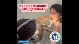 Как промывают миндалины?