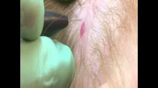Cherry Angioma removal with electrolysis BIAE