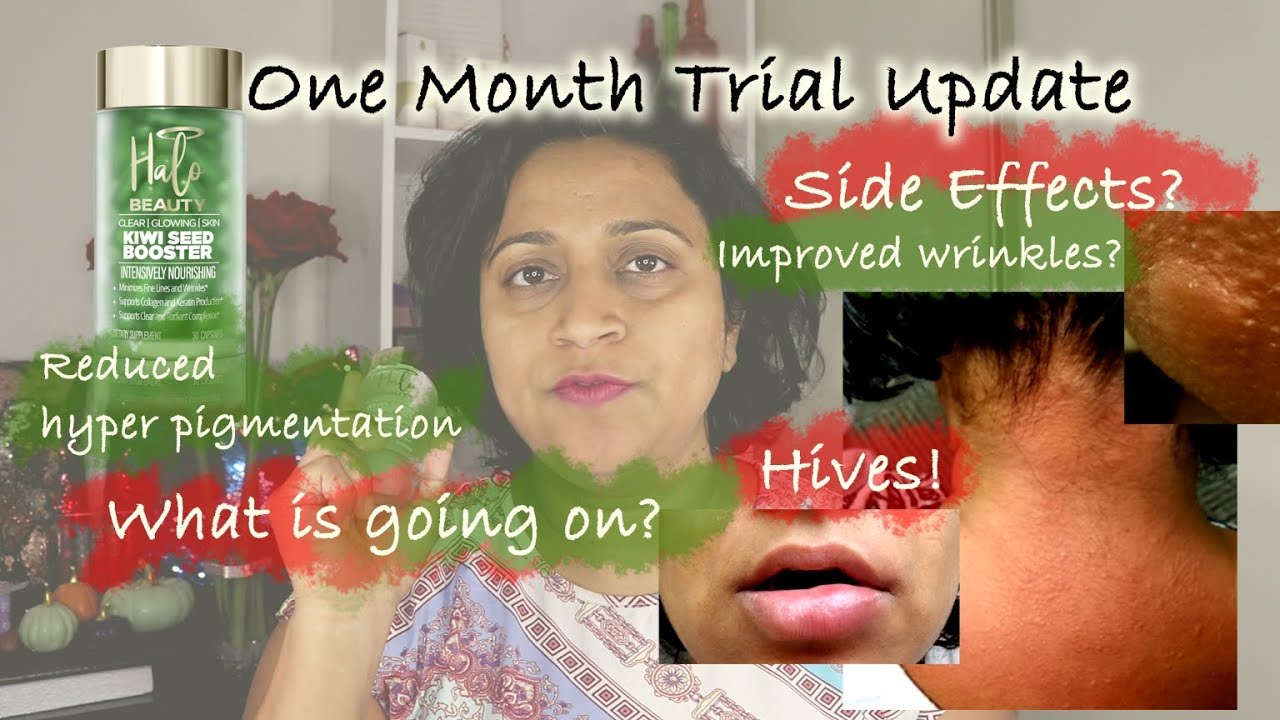 Halo Beauty Kiwi Review One Month Results Before And After Side Effect Halo Beauty Beauty Science Acne And Pimples Halo Beauty Kiwi Review One Month Results Before And After Side Effect Halo Beauty Beauty Science Acne And Pimples