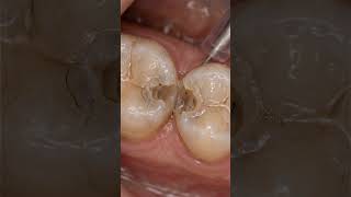 Hidden Decay Between Two Teeth EXPOSED 😳🦷  Satisfying Cavity Restoration #shorts