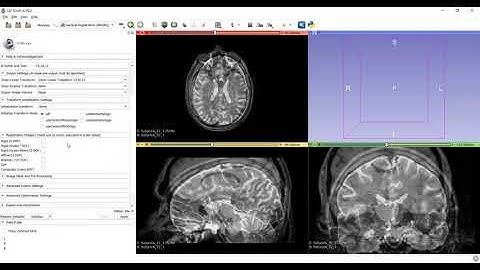 Image registration with 3D slicer