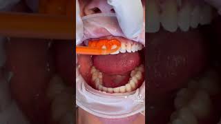 Dental Tartar Dentist New #shorts #2022 screenshot 3