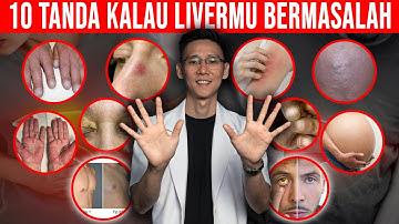 10 Tanda Di Kulit Pada Saat Liver atau Hati Bermasalah