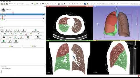 3D Slicer Tutorial_Chest CT