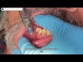 Incisive dental injection