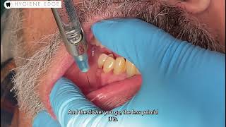 Incisive dental injection by Hygiene Edge 2,163 views 4 weeks ago 1 minute, 4 seconds