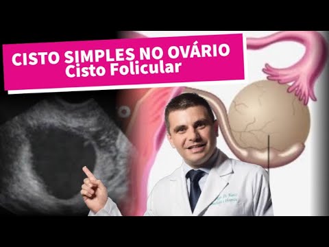 Vídeo: Tratamento De Cistos Ovarianos Foliculares Com Remédios Populares