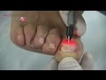 Mycoses des ongles   le traitement au laser  all docteurs