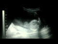 Teazrs ultrasound 2009
