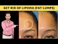 DO THIS ONCE A DAY & Get Rid Of Lipoma | 3 Natural Ways to Treat Fat Lumps (Lipoma)