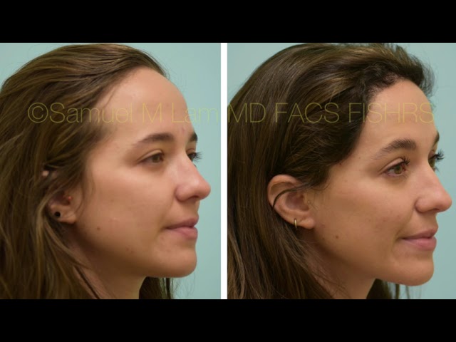 Dallas Female Hairline Lowering Before and After