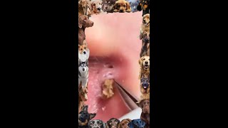 Blackhead removal video | Ear Blackhead extraction | #blackheads